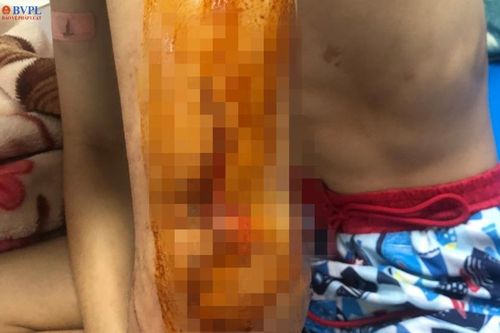 Một sinh lớp 10 ở Đắk Lắk bị đâm trọng thương 2 tay