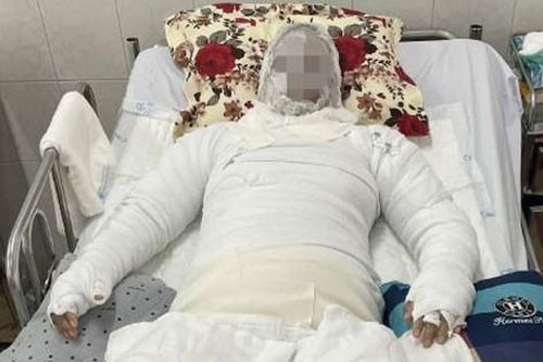 Thai phụ 37 tuần may mắn giữ được con khi bị bỏng nặng do gia đình dùng cồn nướng mực