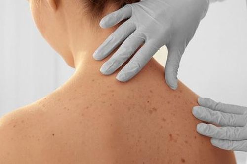 Các yếu tố gây ung thư da và cách phòng ngừa