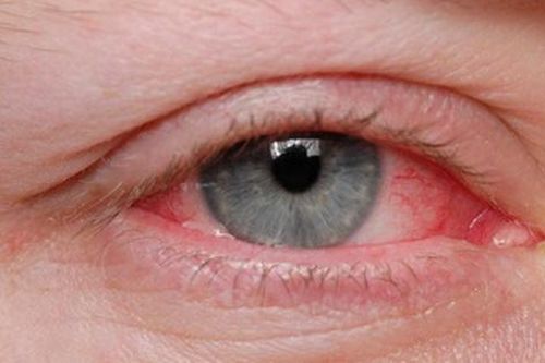 Nguyên nhân gây đau mắt đỏ và cách dùng thuốc điều trị