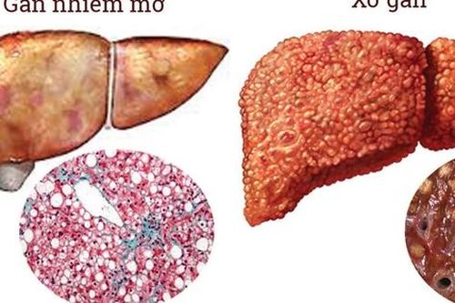 Gan nhiễm mỡ có mấy loại, cần phân biệt như thế nào?