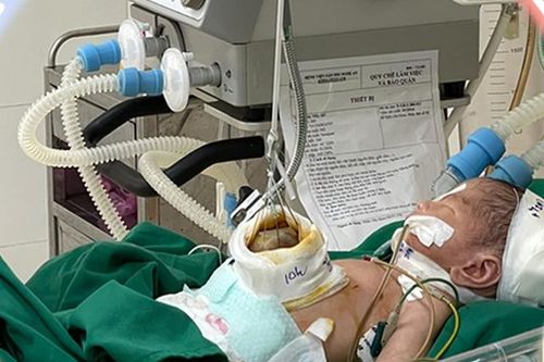 Cứu sống trẻ sơ sinh bị thoát vị cuống rốn phức tạp