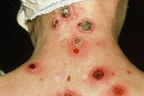 Phát hiện 2 trường hợp mắc giang mai ác tính hiếm gặp