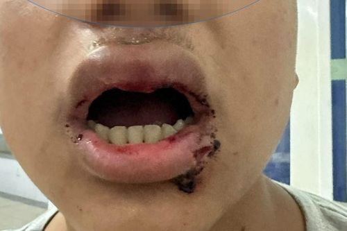 Đà Nẵng: Điều tra vụ nam sinh 14 tuổi bị đánh hội đồng khi đi tắm biển