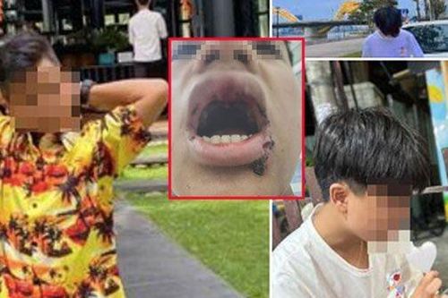Vụ nam sinh Đà Nẵng bị đánh gãy răng khi đi tắm biển: Mẹ nạn nhân tiết lộ lý do
