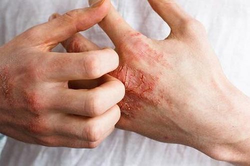 2 bệnh nhân mắc giang mai ác tính hiếm gặp do quan hệ đồng giới