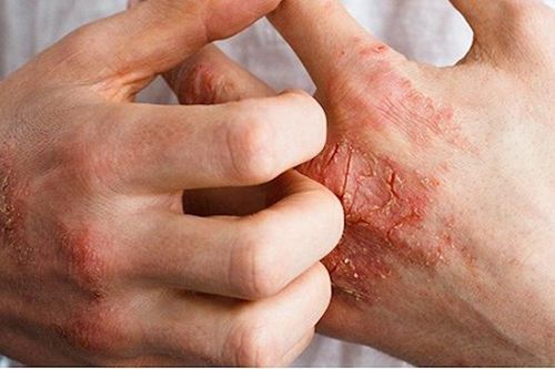 Bị vảy nến nên ăn gì, kiêng gì?