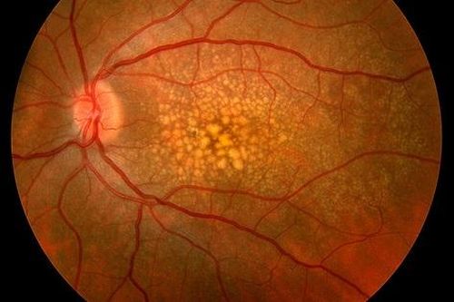 Các phương pháp trị thoái hóa hoàng điểm