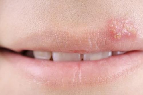 Lưu ý khi điều trị zona thần kinh để bệnh nhanh khỏi