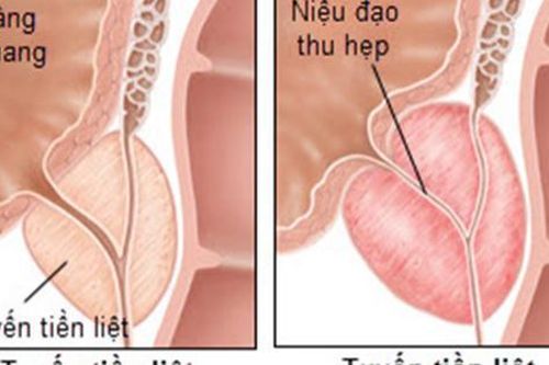 Món ăn bài thuốc hỗ trợ trị viêm tuyến tiền liệt