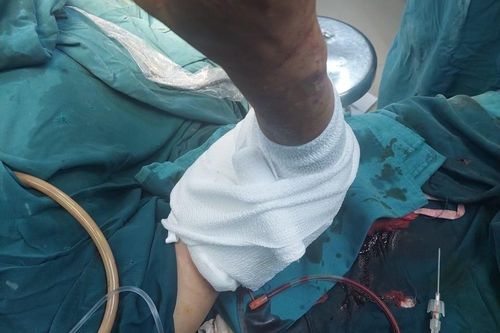 Nối liền cánh tay đứt lìa do bị máy cưa cắt