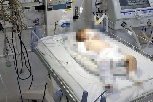 Bé gái bị bạo hành chấn thương sọ não đang phải thở máy