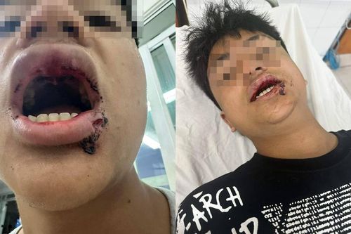 Nam sinh 14 tuổi bị đánh gãy răng, rách môi khi đi tắm biển ở Đà Nẵng