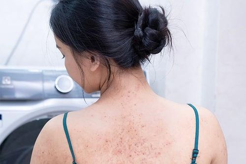 Chia sẻ của bác sĩ Đào Xuân Hưởng về phương pháp trị viêm nang lông