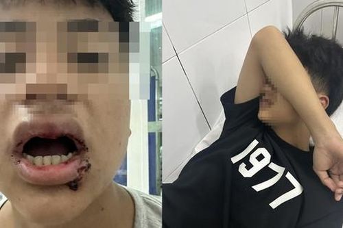 Vụ bé trái 14 tuổi bị đánh đập dã man trên bãi biển: Hành vi côn đồ, hung hãn