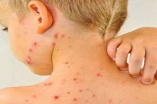 Điều trị chốc lở ở trẻ em trong mùa hè