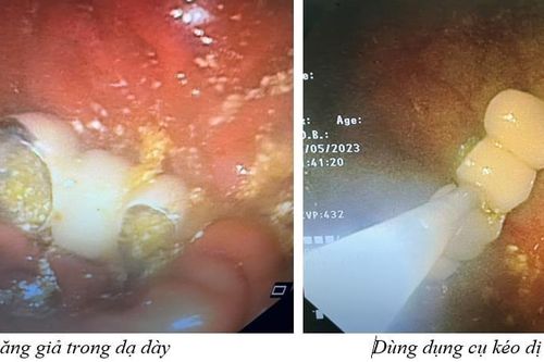 Người phụ nữ sơ ý nuốt 4 chiếc răng giả vào bụng