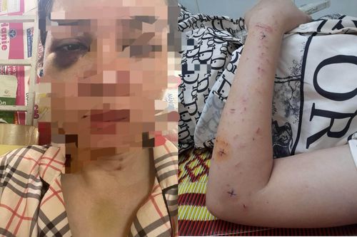 Người phụ nữ bị chồng cũ đánh nhập viện trước ngày sinh nhật