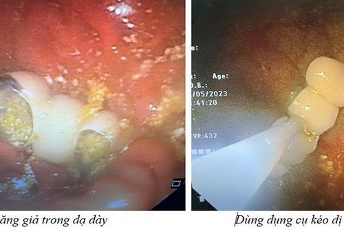 Hy hữu: 4 chiếc răng giả 'lạc trôi' vào dạ dày