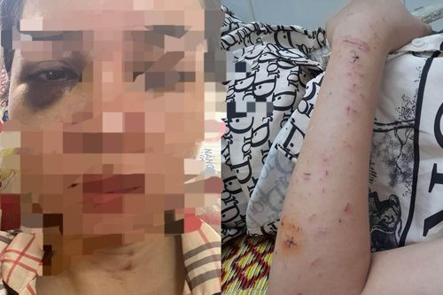 Người phụ nữ Quảng Trị bị chồng cũ đánh nhập viện trước ngày sinh nhật