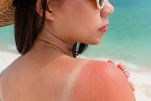 5 cách bảo vệ da và chữa cháy nắng