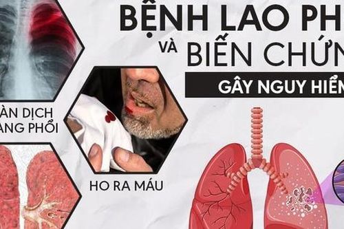 Ngày càng nhiều trường hợp người bệnh trẻ tuổi mắc bệnh lao