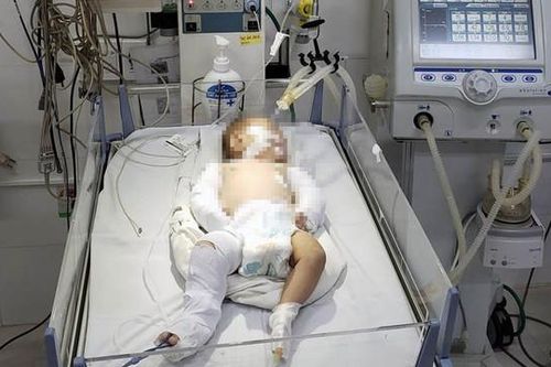 Xót xa hình ảnh bé 2 tháng tuổi nguy kịch do người tình của mẹ bạo hành