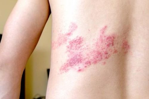 Bệnh zona dễ nhầm lẫn với bệnh nào?