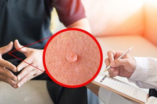 Vì sao mụn cóc sinh dục dễ lây, khó chữa?