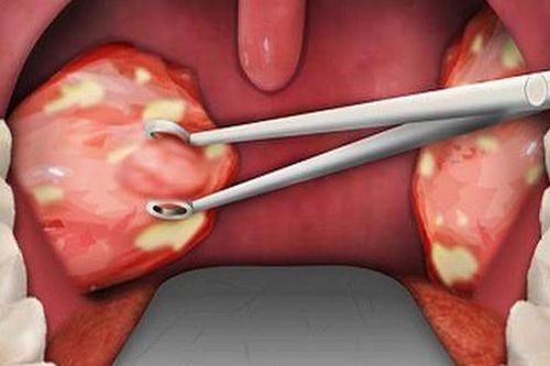 Các biến chứng thường gặp khi cắt amidan