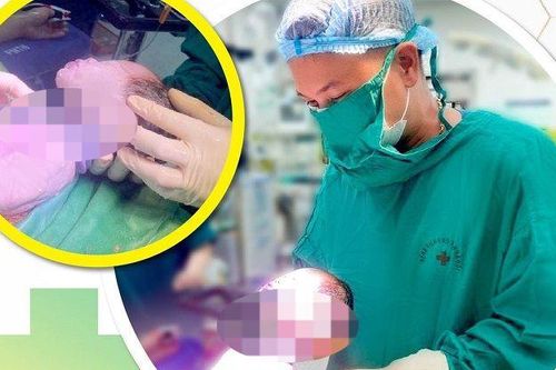 Em bé có 5 vòng dây rốn quấn cổ chào đời an toàn