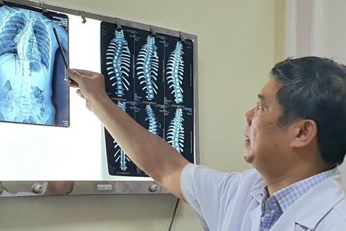 Trẻ bị vẹo cột sống, cách cha mẹ có thể phát hiện bệnh sớm