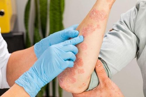 Điều trị viêm đa cơ, viêm da cơ tự miễn