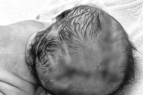 Em bé chào đời phải nhập viện khâu 21 mũi vì sai lầm của người nhà