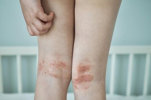 Những lưu ý cho người viêm da cơ địa khi trời nắng nóng