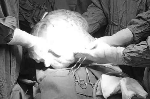 Nghĩ béo bụng người phụ nữ ở Tuyên Quang bất ngờ với khối u nặng gần 7kg