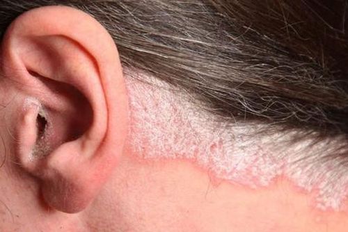 Bệnh vẩy nến có lây không?
