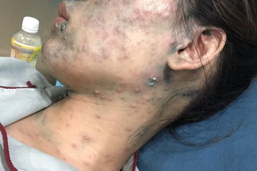 Thai phụ 22 tuần nhập viện cấp cứu do thủy đậu bội nhiễm
