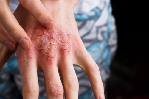 Người đàn ông mắc bệnh hiếm gặp do... giun