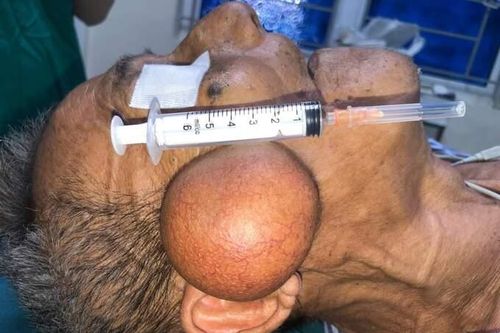 10 năm mang khối u lớn trên mặt