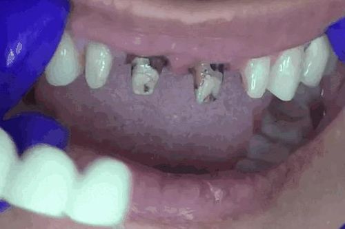 Vì sao người Cổ đại thường có hàm răng thẳng, răng khôn mọc chuẩn chỉnh?