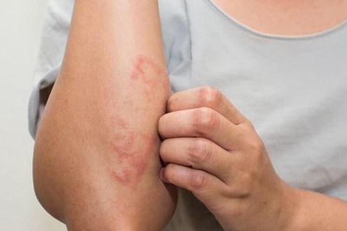 Nắng nóng, tăng bệnh nhân mắc bệnh ngoài da