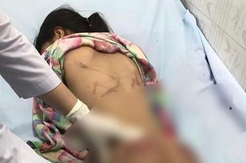 Điều tra vụ bé gái bị chi chít vết thương khi ở với cô họ