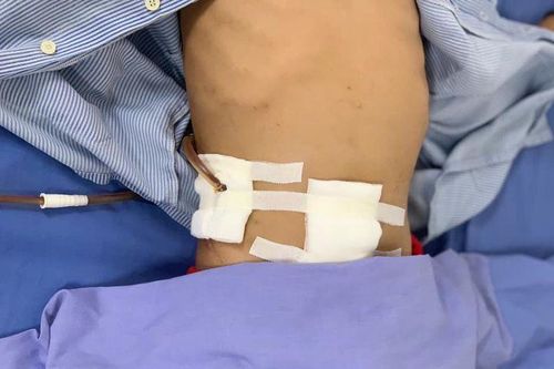 Bé trai bị que sắt đâm thấu bụng