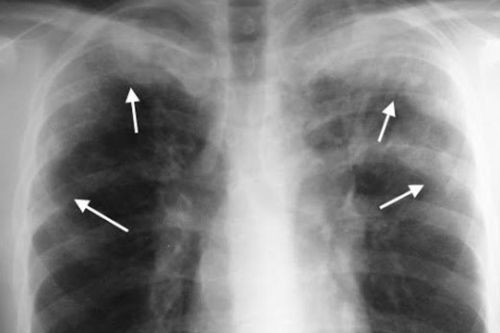 Không tẩy giun nhiều năm, người đàn ông ở Phú Thọ mắc bệnh hiếm