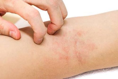 Điều trị và chăm sóc viêm da cơ địa vào mùa hè