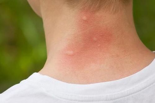 Côn trùng đốt có thể gây nguy hiểm và cách xử trí