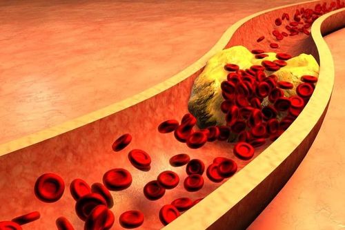 Bệnh tăng cholesterol máu gia đình di truyền: Nguy cơ tử vong cao do không được điều trị đầy đủ