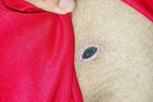 2 người đàn ông sốt cao nhiều ngày liên tục do côn trùng đốt