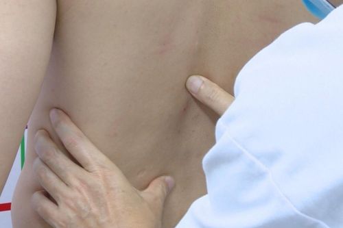 Gãy xương sườn, tổn thương đốt sống sau khi bẻ khớp